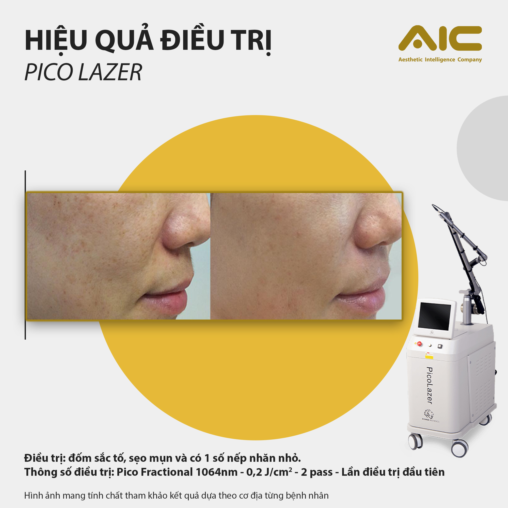 Hiệu quả điều trị sẹo mụn bằng Pico laser