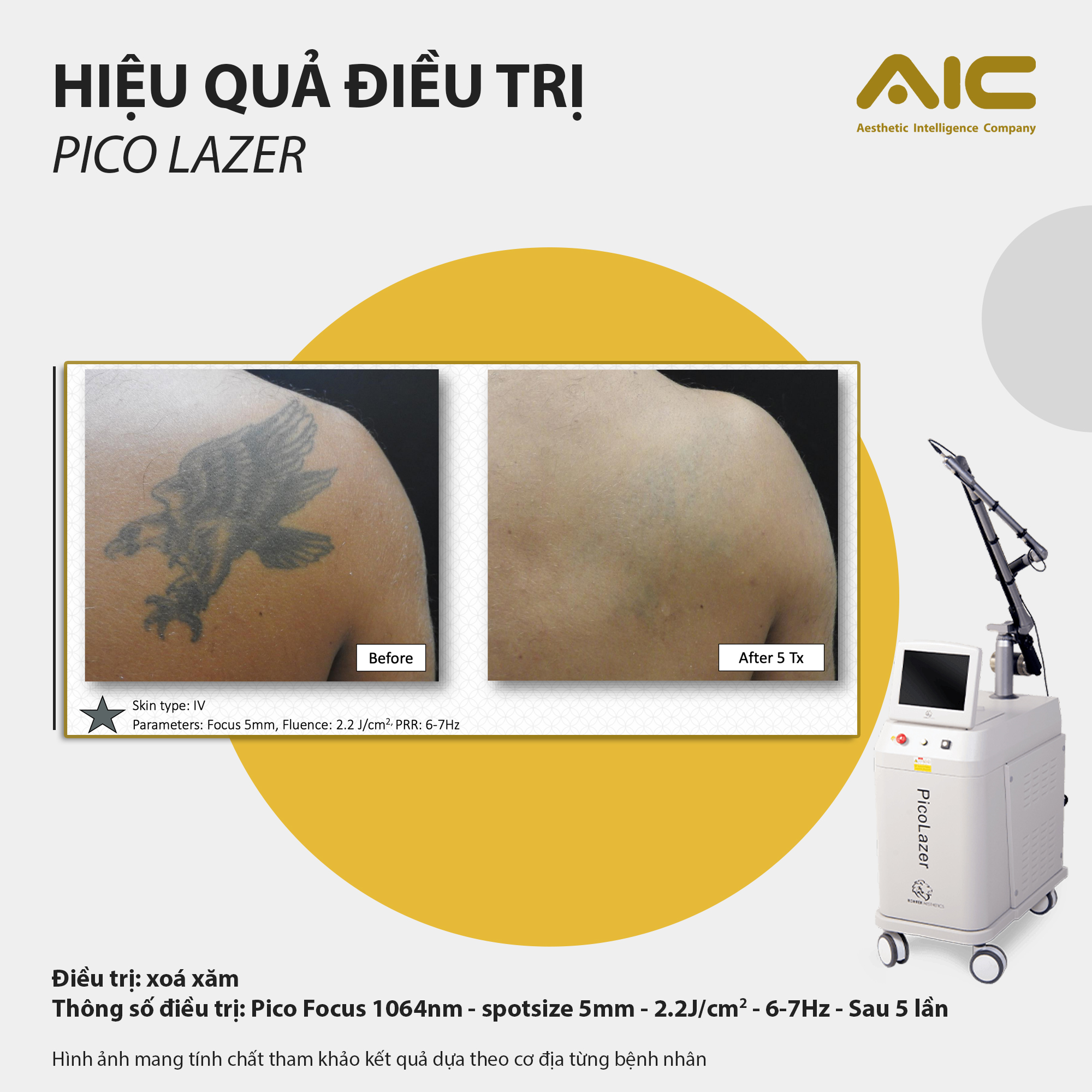 xóa xăm bằng pico laser