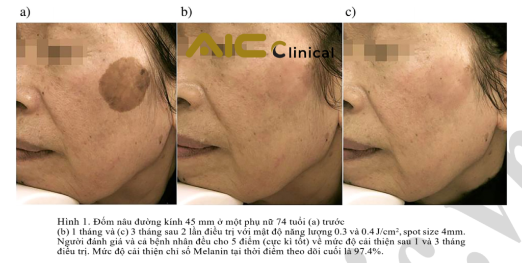 Diều trị đốm nâu bằng pico laser