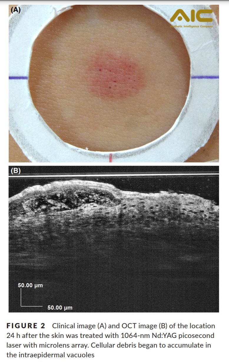 tre-hoa-da-bang-1064nm-pico-laser-aic