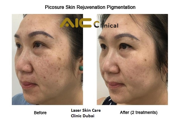 pico laser hiệu quả