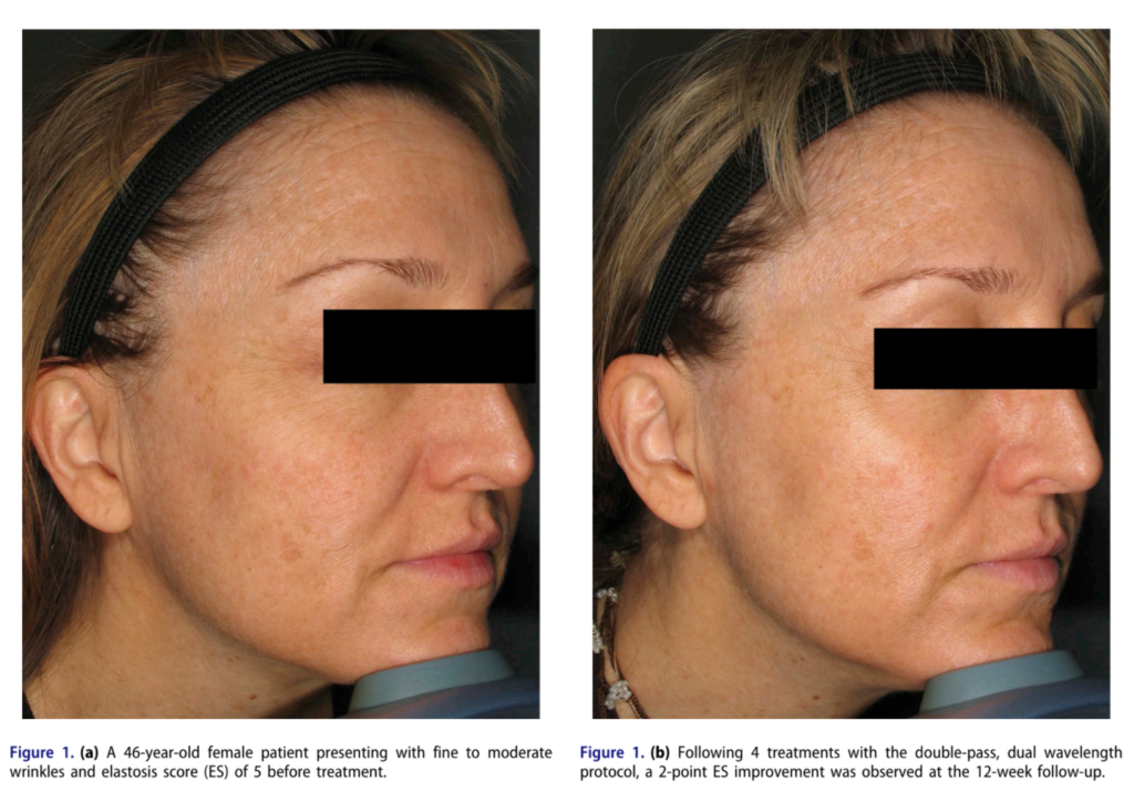 Điều trị nếp nhăn bằng laser picosecond