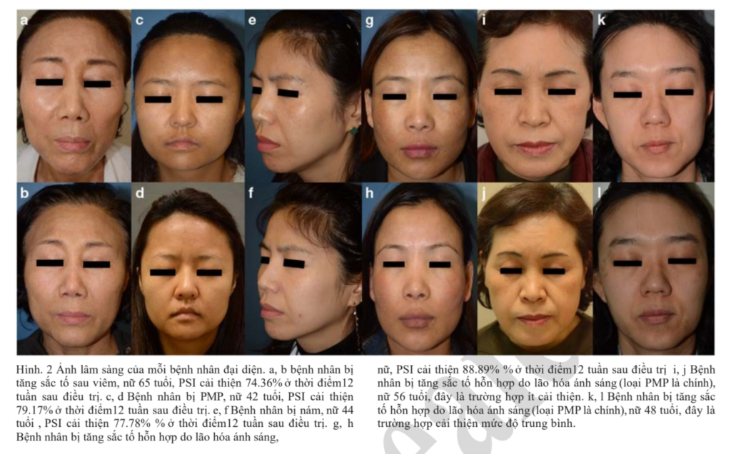 Hiệu quả điều trị tăng sắc tố do lão hóa ánh sáng