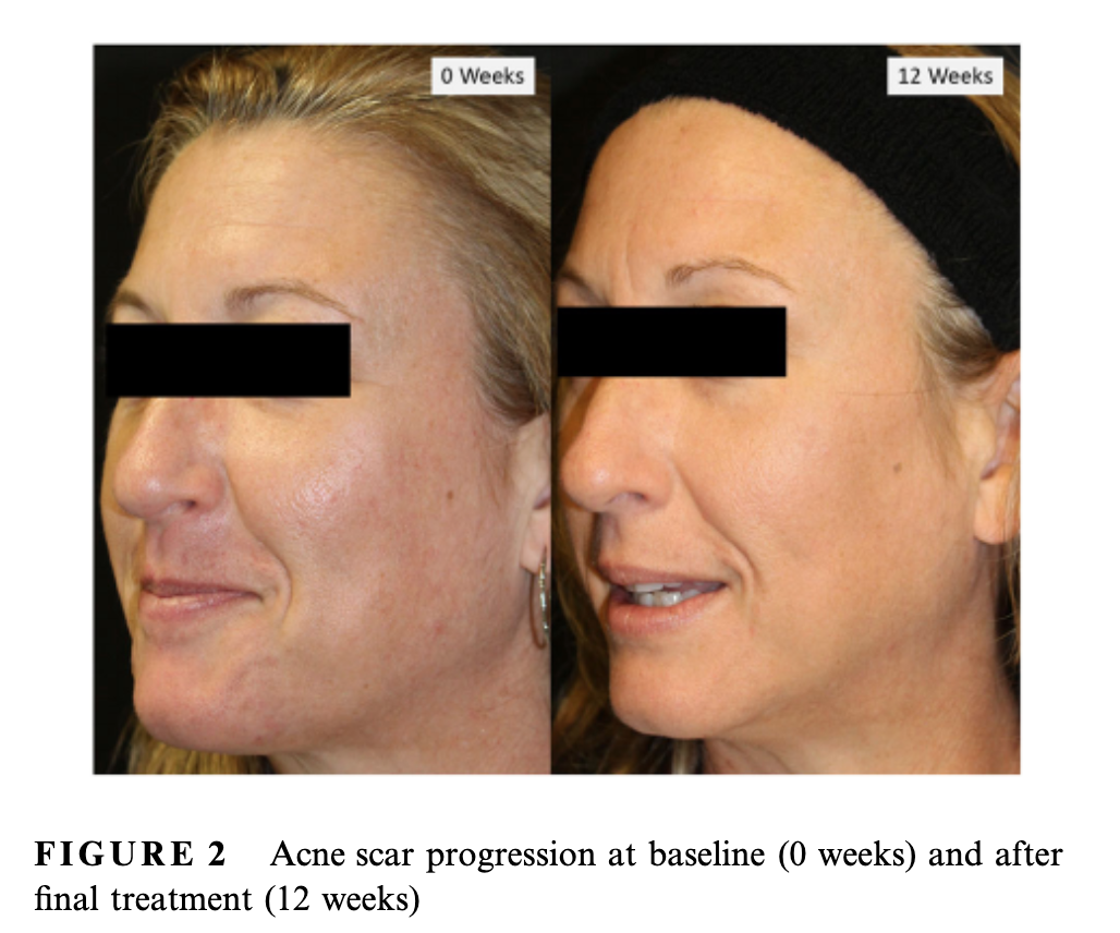 điều trị sẹo mụn bằng Venus Viva MD