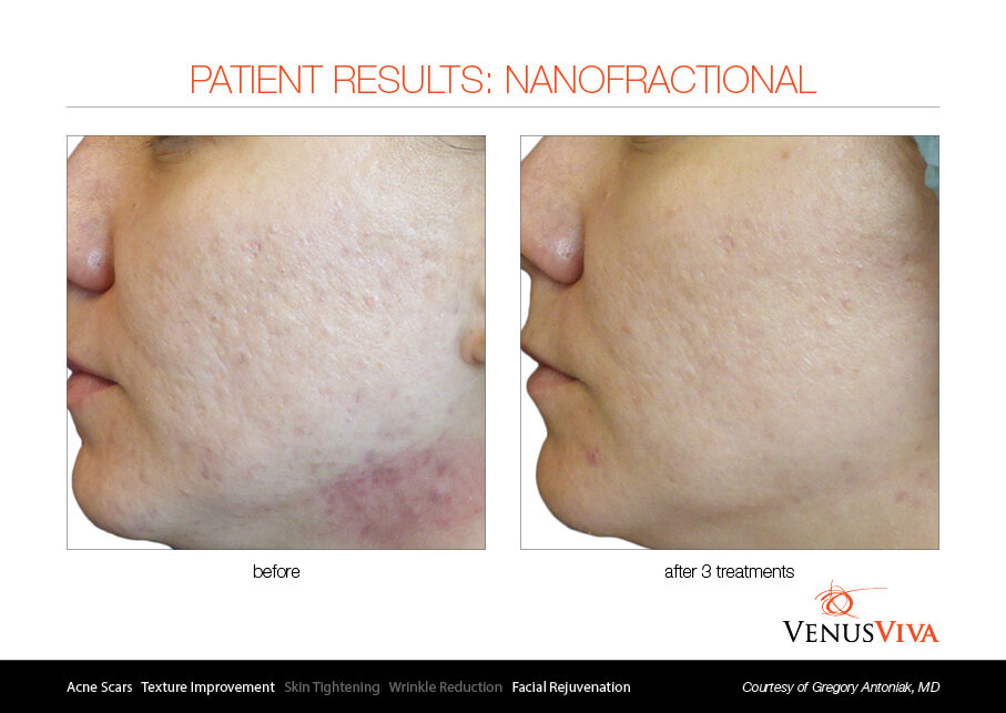 RF vi điểm venus viva điều trị sẹo mụn