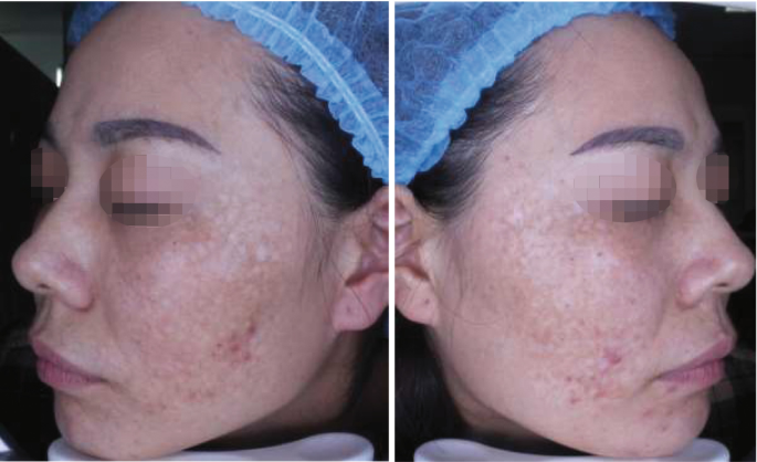 biến chứng giảm sắc tố