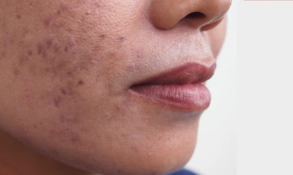 biến chứng tăng sắc tố da