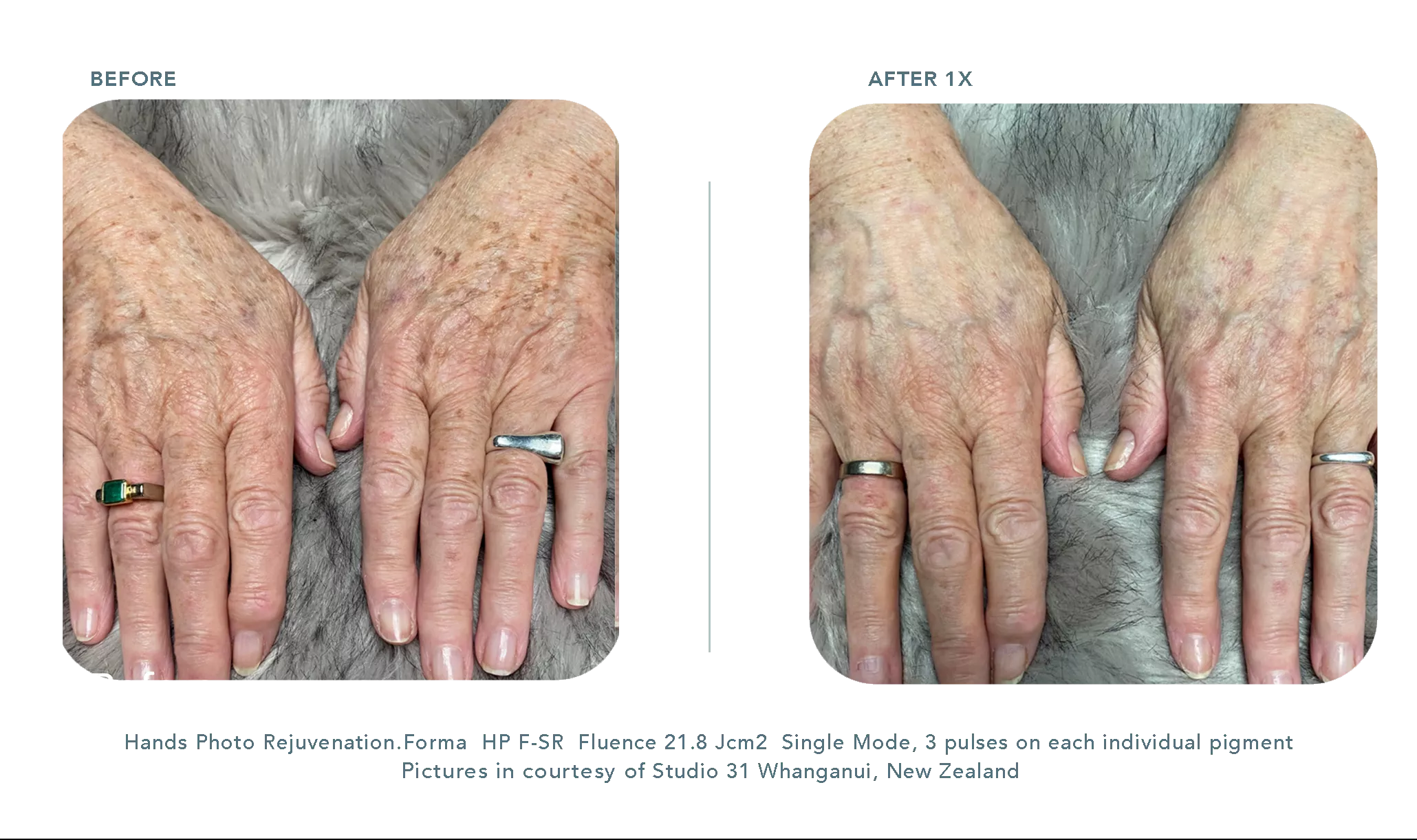 Hand Skin Rejuv Forma System