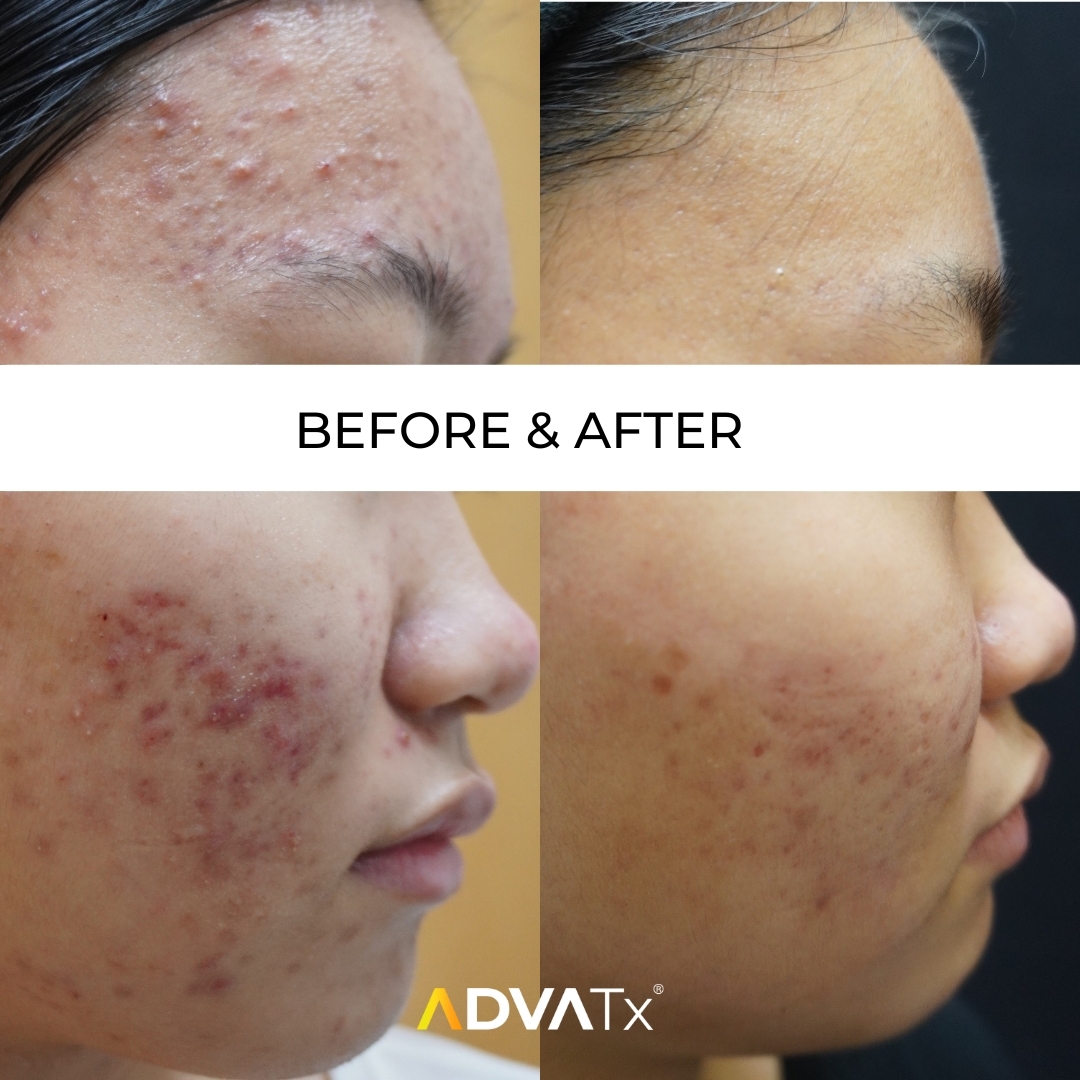 Advatx trị mụn