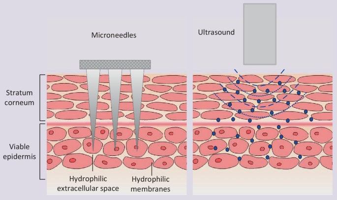 Sonophoresis