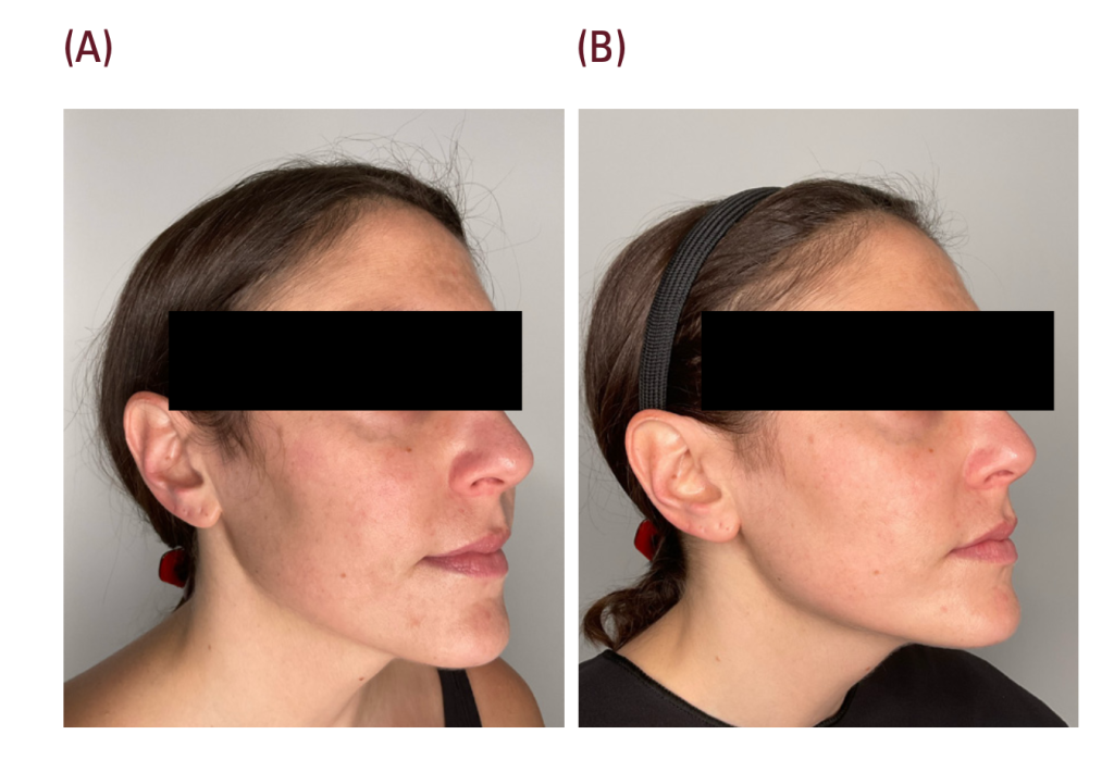 Hiệu quả điều trị melasma bằng laser vàng 589nm advatx