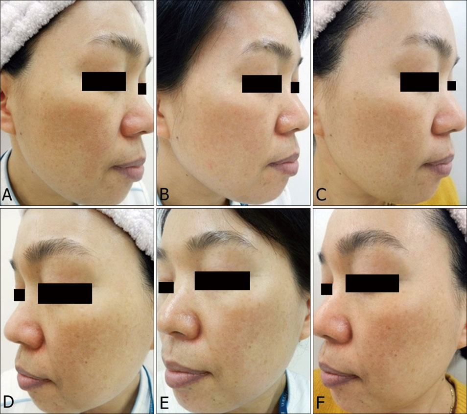 điều trị nám melasma có mạch máu bằng PDL