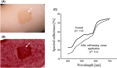 melasma mạch máu